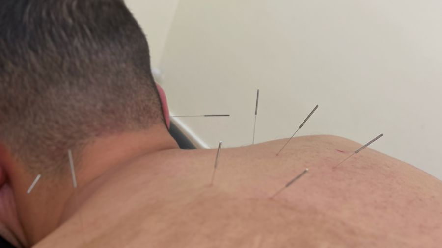 Acupuncture