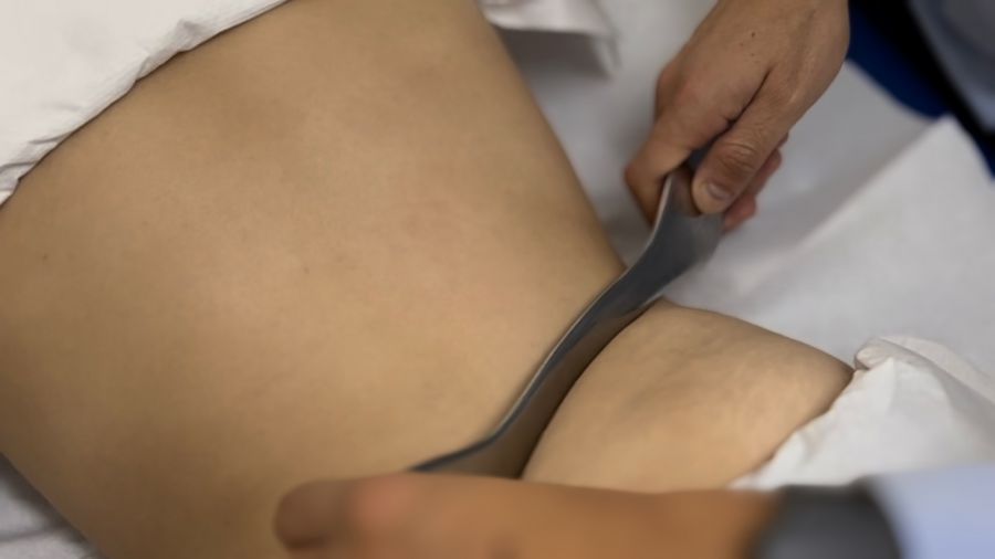 Ergon Technique IASTM Graston Qua Sha